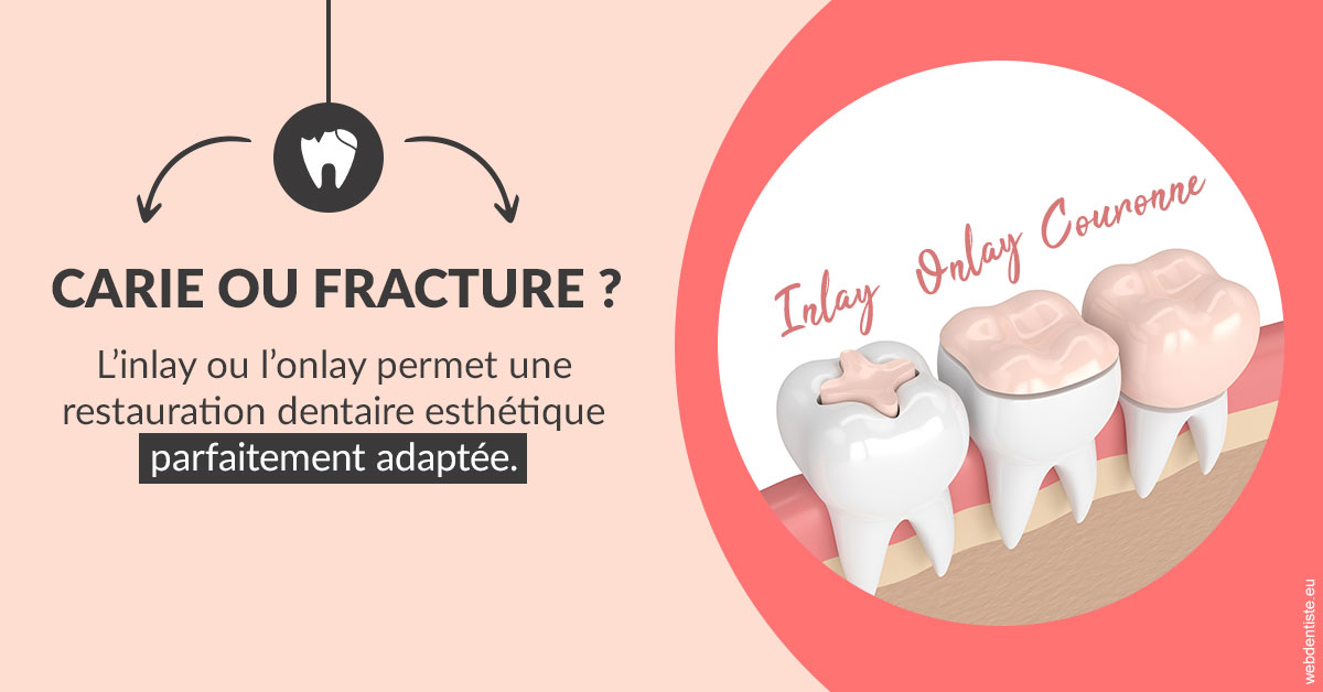 https://dr-jacques-schouver.chirurgiens-dentistes.fr/T2 2023 - Carie ou fracture 2
