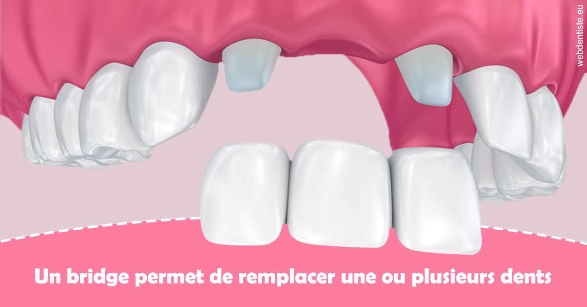 https://dr-jacques-schouver.chirurgiens-dentistes.fr/Bridge remplacer dents 2