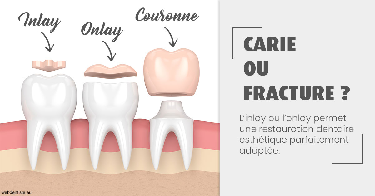 https://dr-jacques-schouver.chirurgiens-dentistes.fr/T2 2023 - Carie ou fracture 1