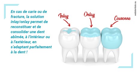 https://dr-jacques-schouver.chirurgiens-dentistes.fr/L'INLAY ou l'ONLAY
