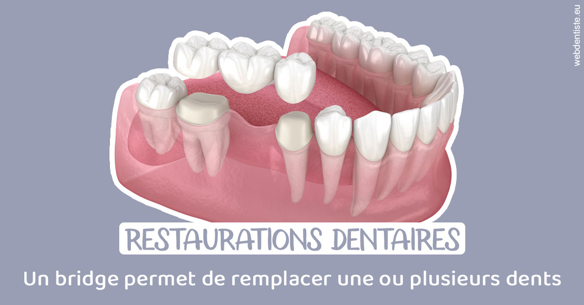 https://dr-jacques-schouver.chirurgiens-dentistes.fr/Bridge remplacer dents 1