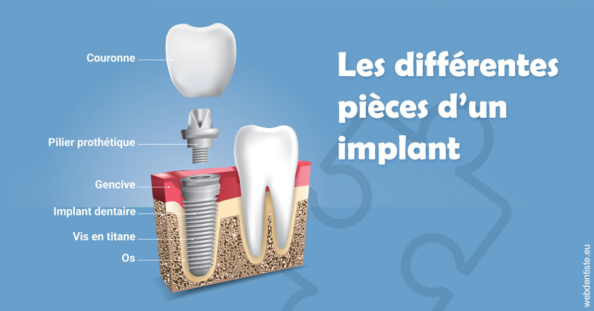 https://dr-jacques-schouver.chirurgiens-dentistes.fr/Les différentes pièces d’un implant 1